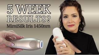 MimiSilk Iris 1450nm Review | My Honest Results After 5 Weeks