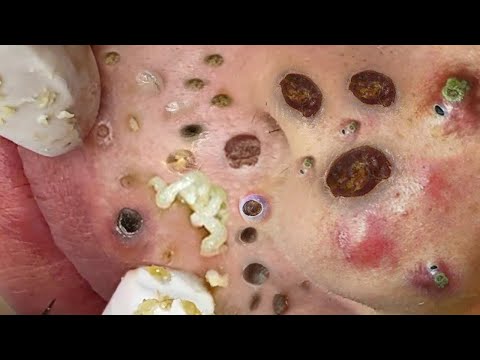 Blackhead Removal With Sac Dep Spa @100074552