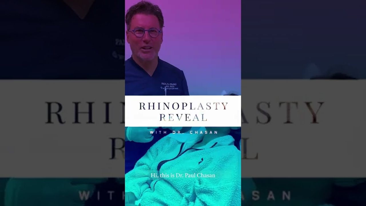 Rhinoplasty Reveal - #15