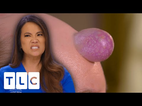 Dr. Lee Treats Anxious Patient With Enormous Forehead Cyst | Dr. Pimple Popper
