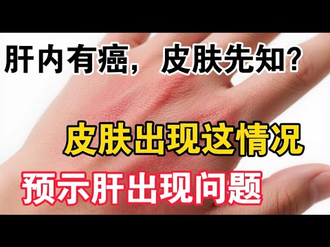 肝内有癌，皮肤先知？皮肤出现这种问题预示肝功能受损，多喝一种茶，排肝毒养肝护肝，【靜談養生】