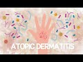 Atopic Dermatitis and Skin Integrity