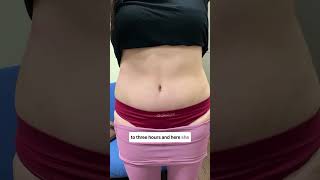 Tummy tuck before and after results!