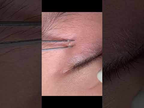 빠져드네~🙀 #blackheads #blackheadcaique #여드름 #피부 #피부관리