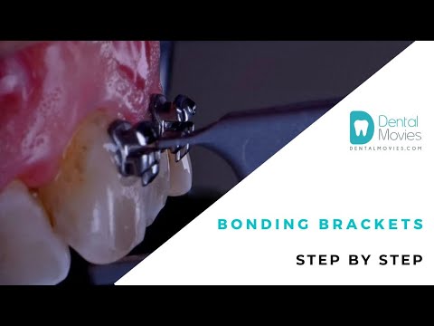 Bonding brackets step by step