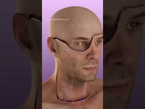أول عمليه نقل عين في العالم 👁️
