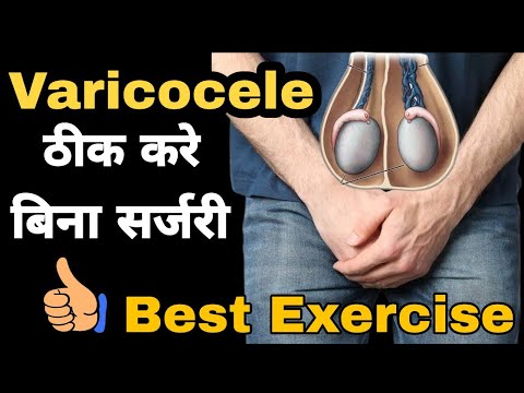 Varicocele exercise in hindi. बिना सर्जरी Varicocele का ईलाज। Varicocele treatment Without Surgery.