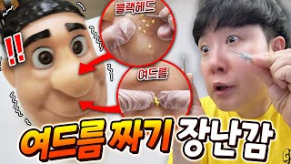쾌감 뭐지..?! 블랙헤드, 여드름 인정사정 없이 모두 짜버릴 수 있는 장난감을 가져왔습니다
