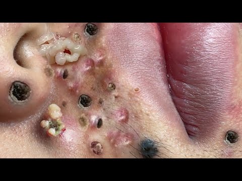 Blackhead Removal With Sac Dep Spa @100074554
