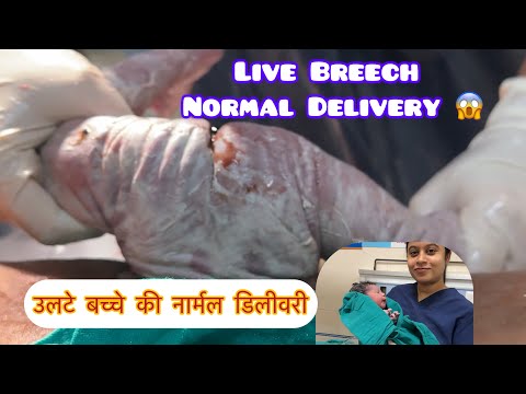 live Breech Delivery😱 # fully dilated patient ki vaginal delivery Leni PADI in breech