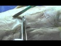 Accessing Erector Spinae Muscles