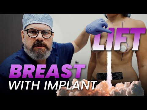 Breast Lift with Implants: Surgical Markings Explained
