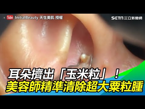 耳朵擠出「玉米粒」！美容師精準清除超大粟粒腫  ｜三立新聞網SETN.com