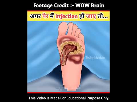 अगर पैर में Infection हो जाए तो... #asmr #viral