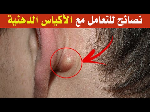 ما يجب أن تعرفه عن الأكياس الدهنية ونصائح مهمة للتعامل معها