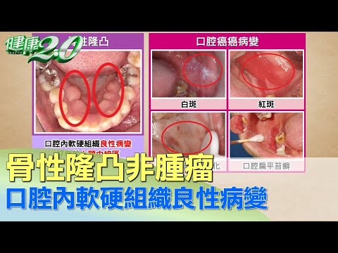 骨性隆凸非腫瘤 口腔內軟硬組織良性病變 健康2.0