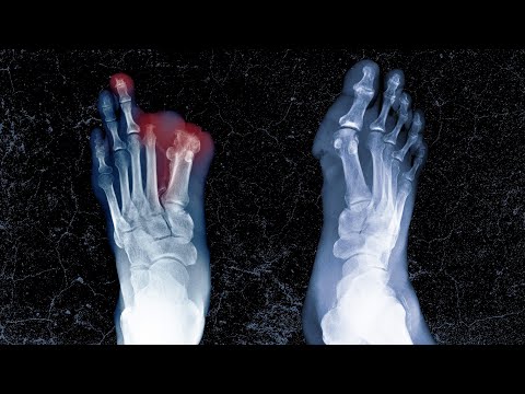 A Student Ate Suspicious Leftovers For Lunch. This Is What Happened To His Limbs.