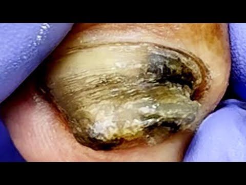 There is congestion inside the onychomycosis!【Xue Yidao】