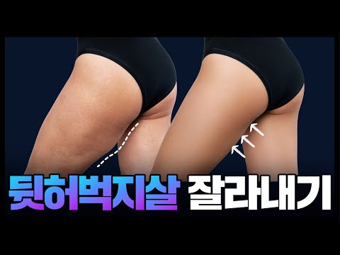 '뒷허벅지 운동'을 해야 앞허벅지가 굵어지지 않습니다✨️