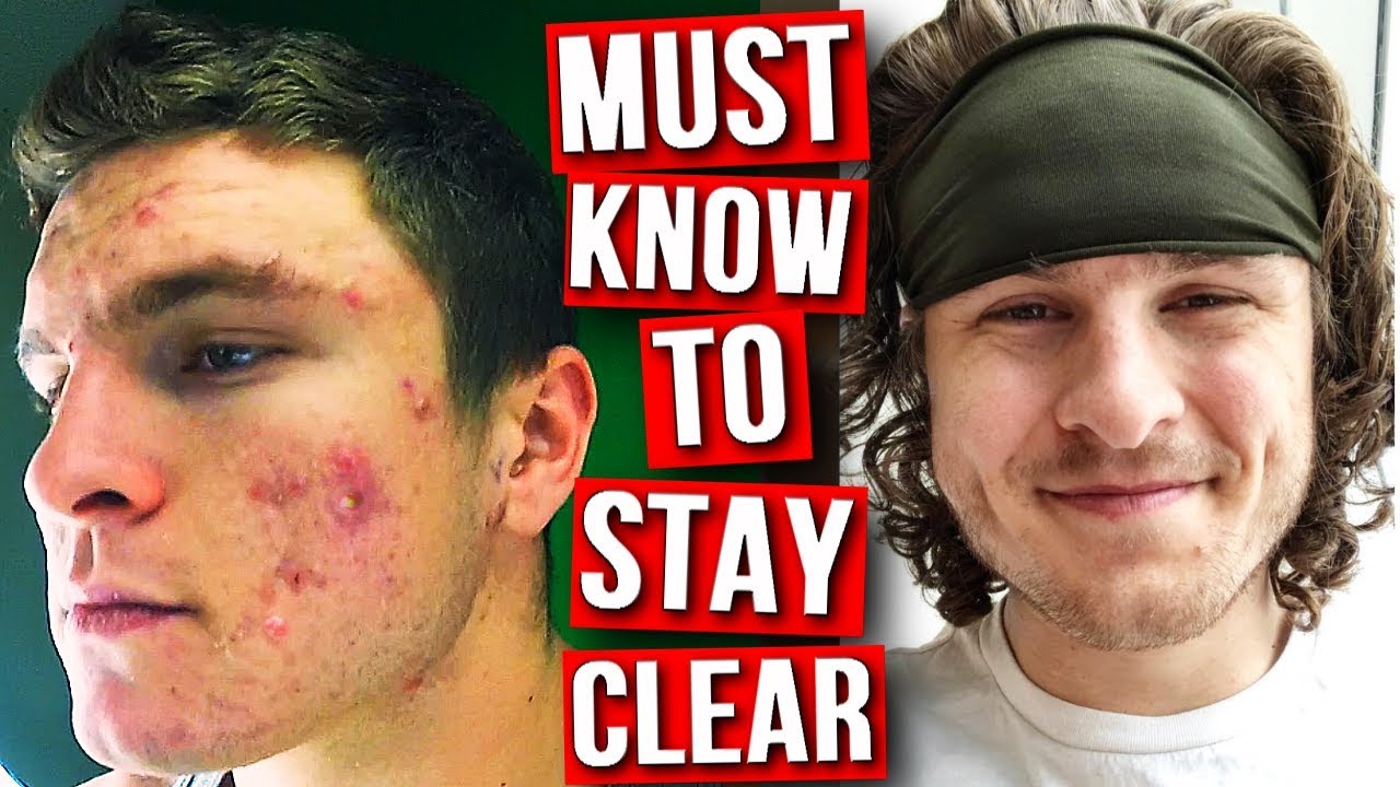 TOP 10 WAYS TO ELIMINATE YOUR ACNE