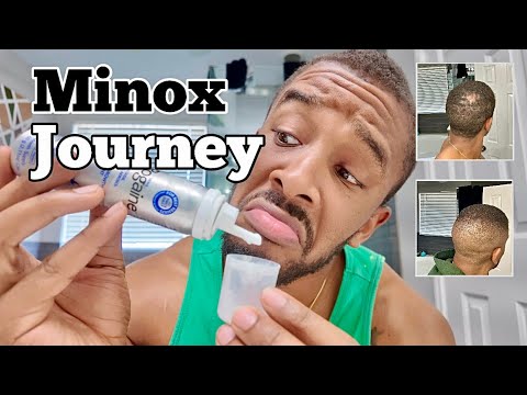 Minoxidil Week 8: Hair Growth UPDATE! 😱 Hiding My Bald Spots for Acting & Modeling!