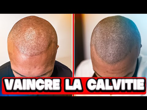 LA TRICOPIGMENTATION LA NOUVELLE TECHNIQUE POUR COMBATTRE LA CALVITIE !