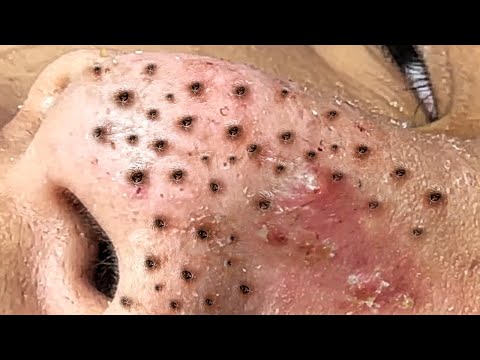 Blackhead Removal With Sac Dep Spa @100074216