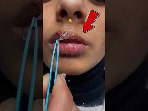 اوعى تقشر شفايفك!
