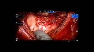 62. Robotic TaTME (transanal total mesorectal excision)