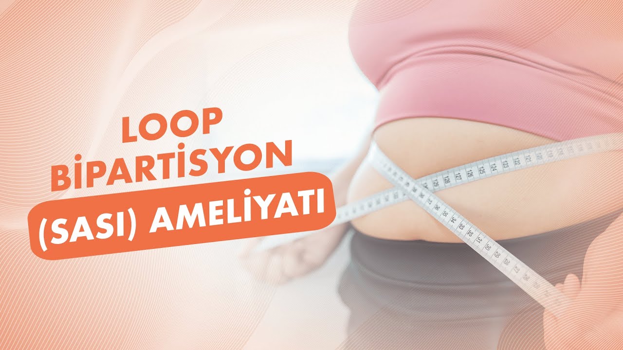 Obezite Cerrahisinde SASI Yöntemi: Obezite Cerrahisi Metabolik Hastalıklara Çözüm Olabilir mi?