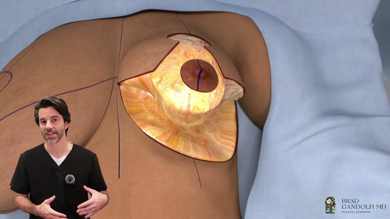 Medical illustration of breast anatomy and procedure.