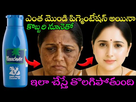 కొబ్బరి నూనెతో ఇలా చేసి చూడండి 20 సంవత్సరాల పిగ్మెంటేషన్ అయినా తొలగిపోతుంది😱 డాక్టర్లు కూడా చెప్పారు