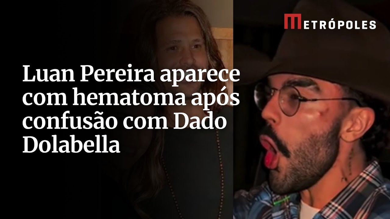 Luan Pereira aparece com hematoma após confusão com Dado Dolabella