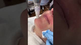 TRY MICRONEEDLING TO STIMULATE COLLAGEN! #microneedling #skincare #shorts