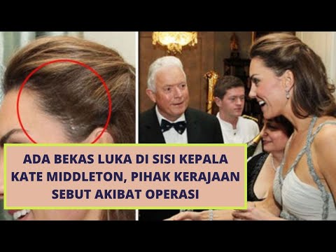 Cerita Carole Temukan Benjolan di Kepala Kate Middleton, Ternyata Berbahaya #katemiddleton #penyakit