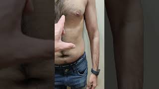 9 years Gynecomastia Surgery result