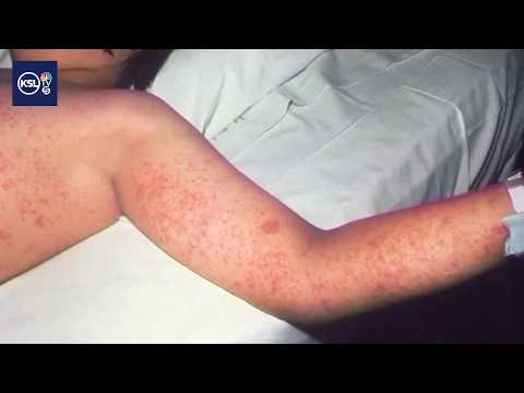 Tooele County confirms first case of measles