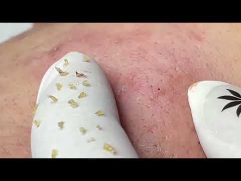 Relaxing acne treatment with Linh My Dang #445#pimplepop #relaxing