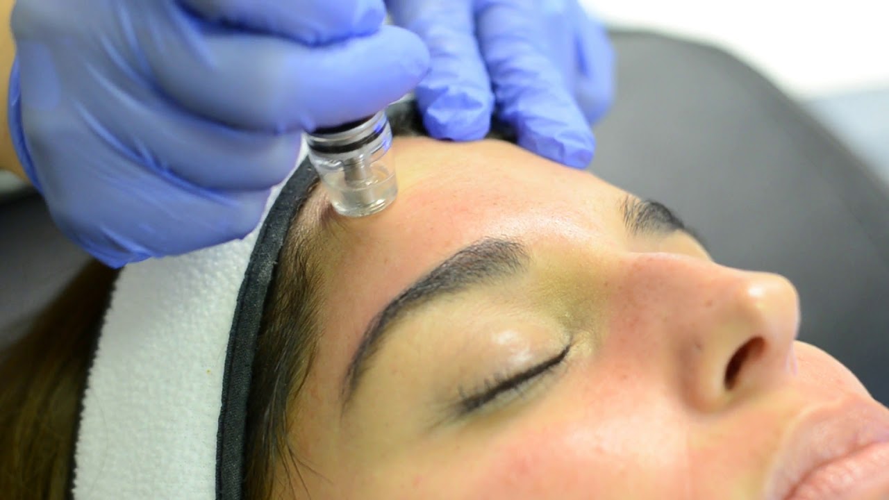 Microneedling treatment on patient's forehead.