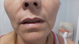 Hipocalcemia