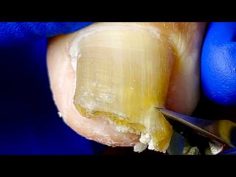 The Complete Trimming Process Of Super Thick Onychomycosis!【Xue Yidao】