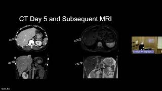 NEJM Case Records of the MGH–A 28-year-old man with headache and vision loss affecting the right eye