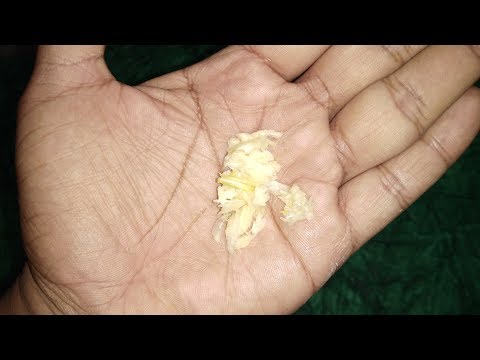 बार बार मुंह में छाले होते हैं तो इस घरेलू नुस्खे का प्रयोग तुरंत कर लो || Mouth Ulcer Home Remedy
