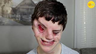 An Autistic Teen Born Without Eyes