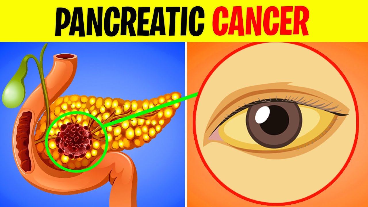 6 Warning Signs of Pancreatic Cancer You Should Never Ignore