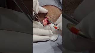 This cyst came out nice and cleanly, so didn't get a squeeze.