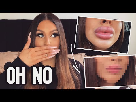 Getting My Lip Filler Dissolved After 6 Years!