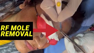 RF mole removal by Dr. Hema Yadav #9958540359