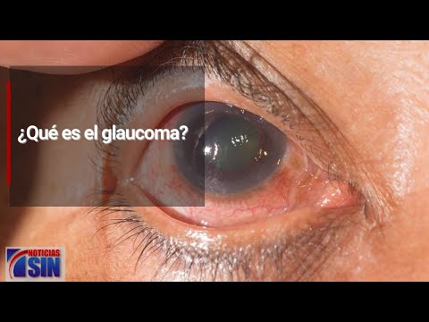 ¿Qué es el glaucoma?