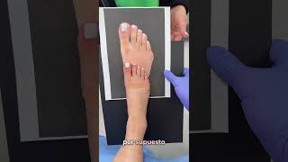 LETS HEAD INTO THE OPERATING ROOM AND TALK ABOUT THE TAILOR’S BUNION💫🦶🏼